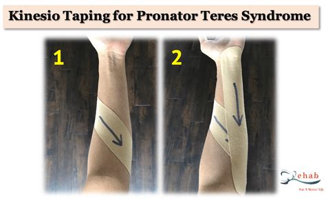 treatment for pronator syndrome